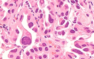 Mesotelioma opamianto